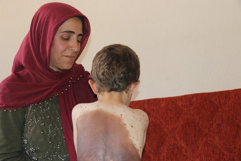 BİTLİS MERKEZDE İKAMET EDEN 6 YAŞINDAKİ KÜÇÜK SAMET VÜCUDUNUN HER