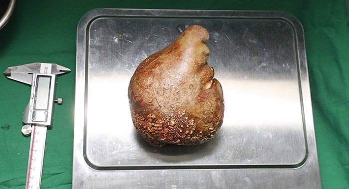 SRİ LANKA'DA BİR HASTADAN 13,37 SANTİMETRE UZUNLUĞUNDA, 801 GRAM AĞIRLIĞINDA