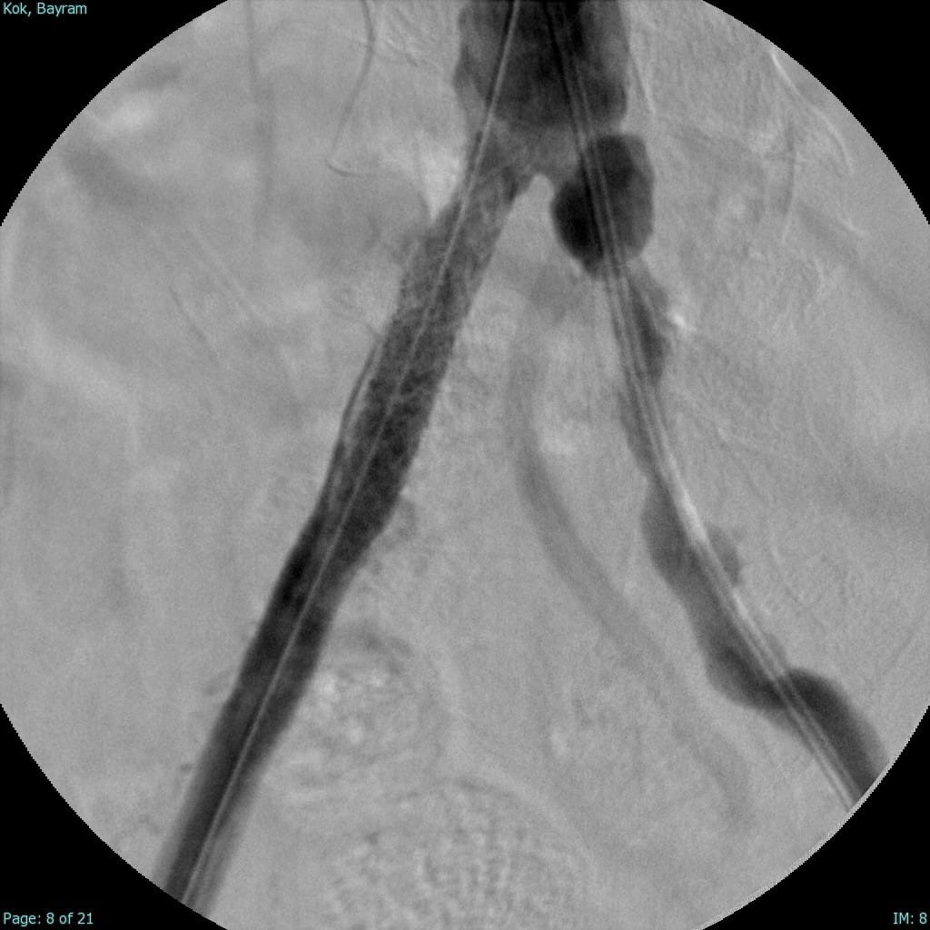 INVAMED TIBBİ CİHAZ TEKNOLOJİ KAMPÜSÜNDE GELİŞTİRİLEN "ATLAS STENT GREFT", BEZMİÂLEM