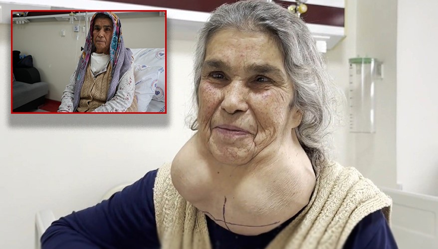 Yıllarca devasa kitleyle yaşadı Boynun ön alt kısmında büyük bir şişliğin oluşmasına rağmen doktorlardan