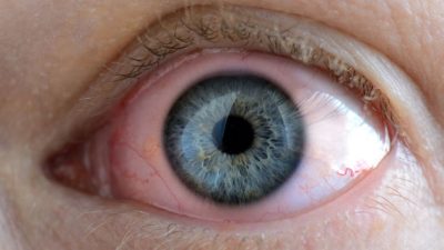 Viral konjonktivitin görülme sıklığının kış aylarında arttığına dikkat çeken Göz