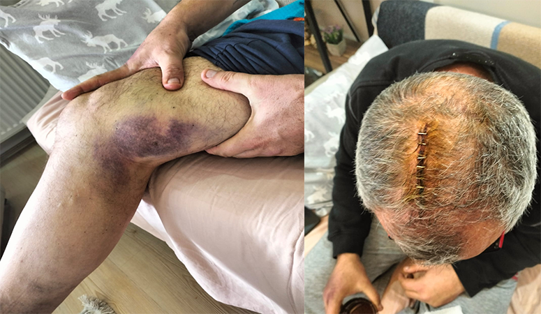 Erdek Belediyesi’ni eleştirdi, hastanelik edilene kadar dövüldü Sosyal medya hesabı üzerinden Erdek Belediyesi ile ilgili eleştiride bulunan
