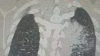 Yaz aylarının gelmesiyle birlikte klima kullanımının artması, çocuklarda ‘lejyoner hastalığı’
