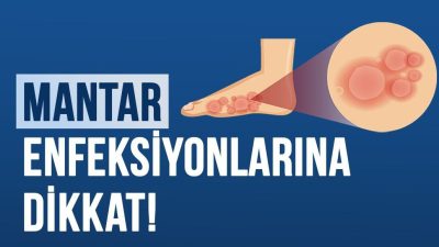 Sağlık Bakanlığı, hijyen kurallarına dikkat ederek mantar enfeksiyonlarının önüne geçilebileceğini