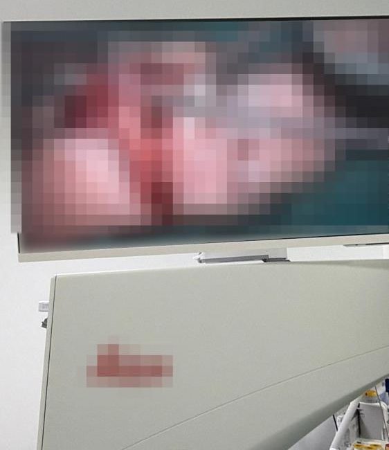 Bandırma’da asansör kazasında kopan parmak başarılı ameliyatla kurtarıldı Bandırma ilçesinde yaşanan asansör kazasında parmağı kopan bir vatandaş, mikrocerrahi